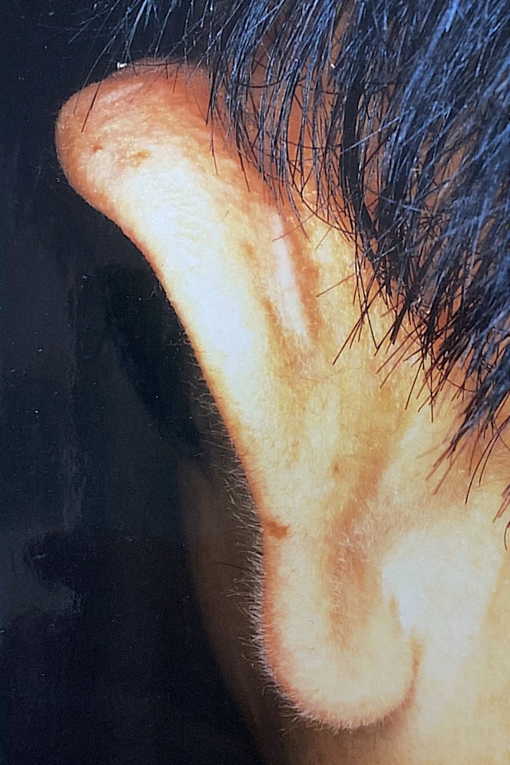 外傷性耳介変形術前　大江橋クリニック