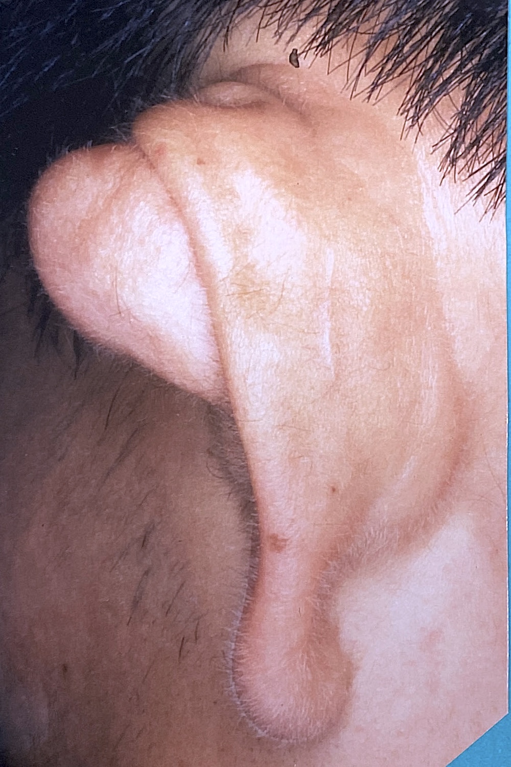 外傷性耳介変形術前　大江橋クリニック