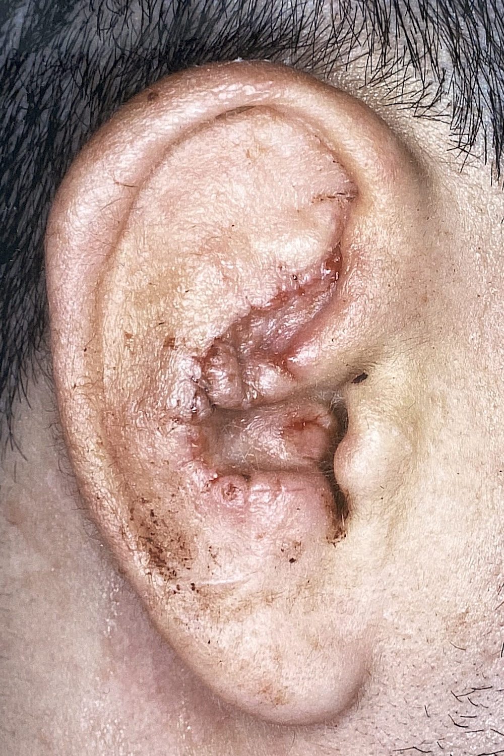 外傷性耳介変形術前　大江橋クリニック