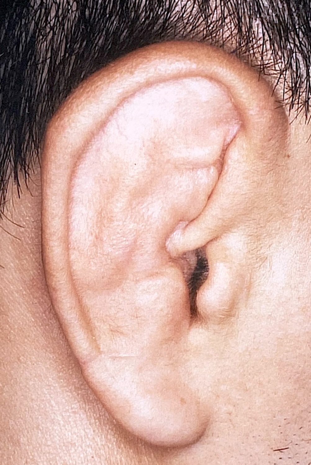 外傷性耳介変形術前　大江橋クリニック