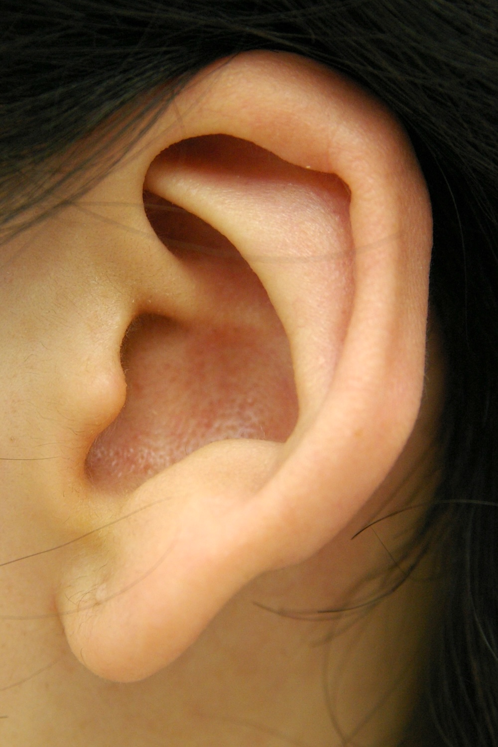 軽度の小耳症術後　大江橋クリニック