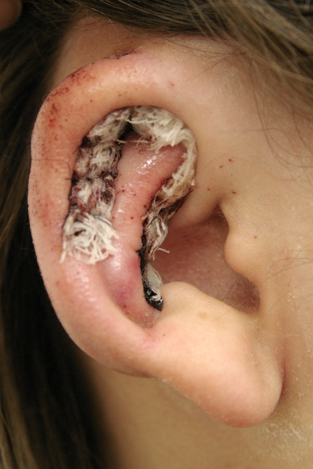 軽度の小耳症術後　大江橋クリニック