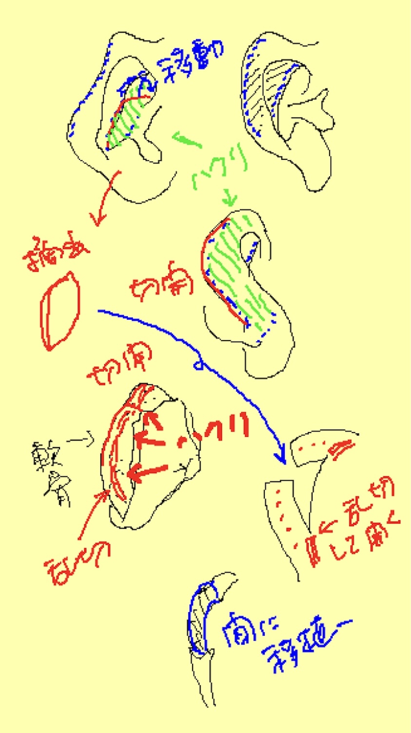軽度の小耳症術後　大江橋クリニック