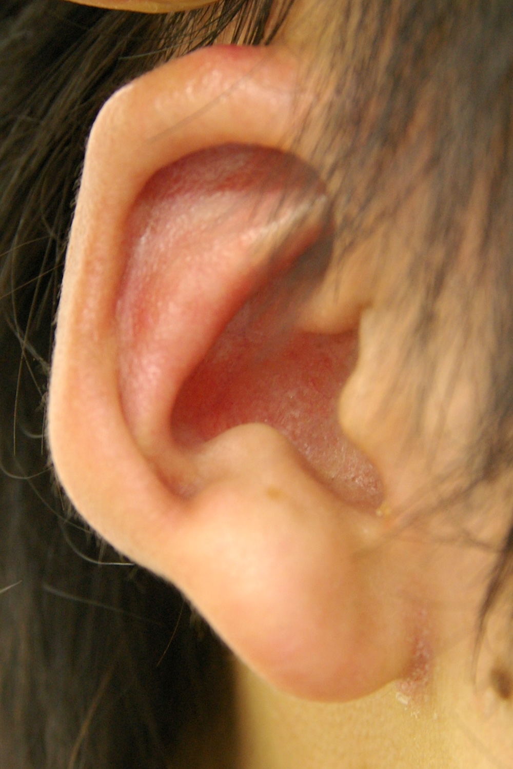 軽度の小耳症術後　大江橋クリニック