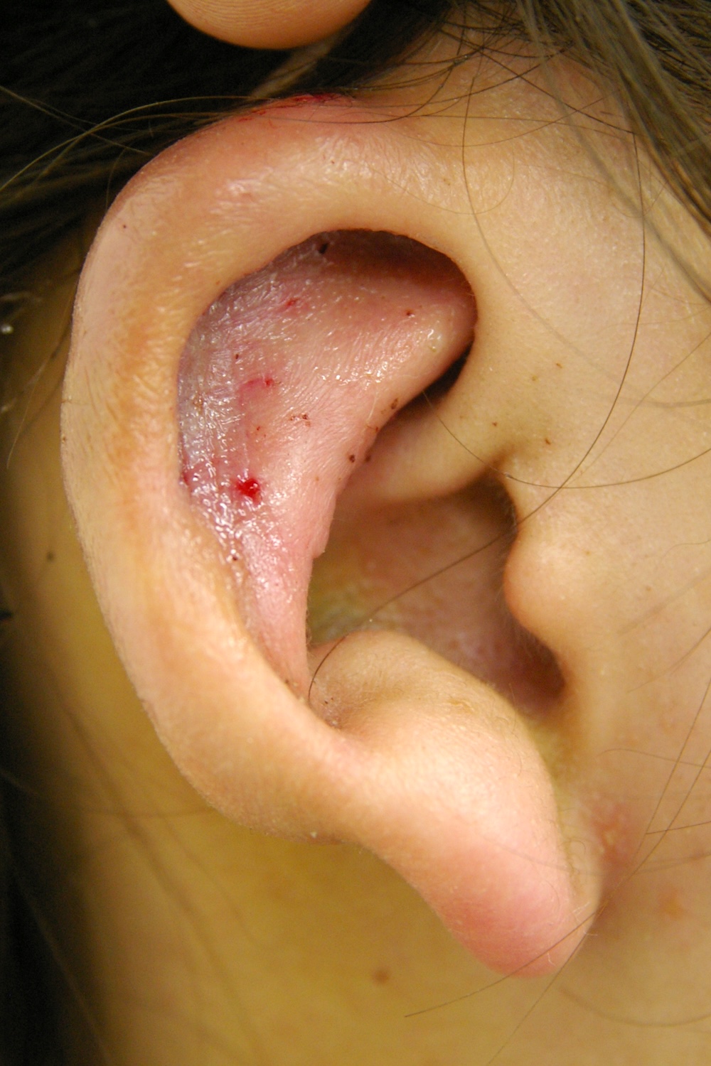 軽度の小耳症術後　大江橋クリニック