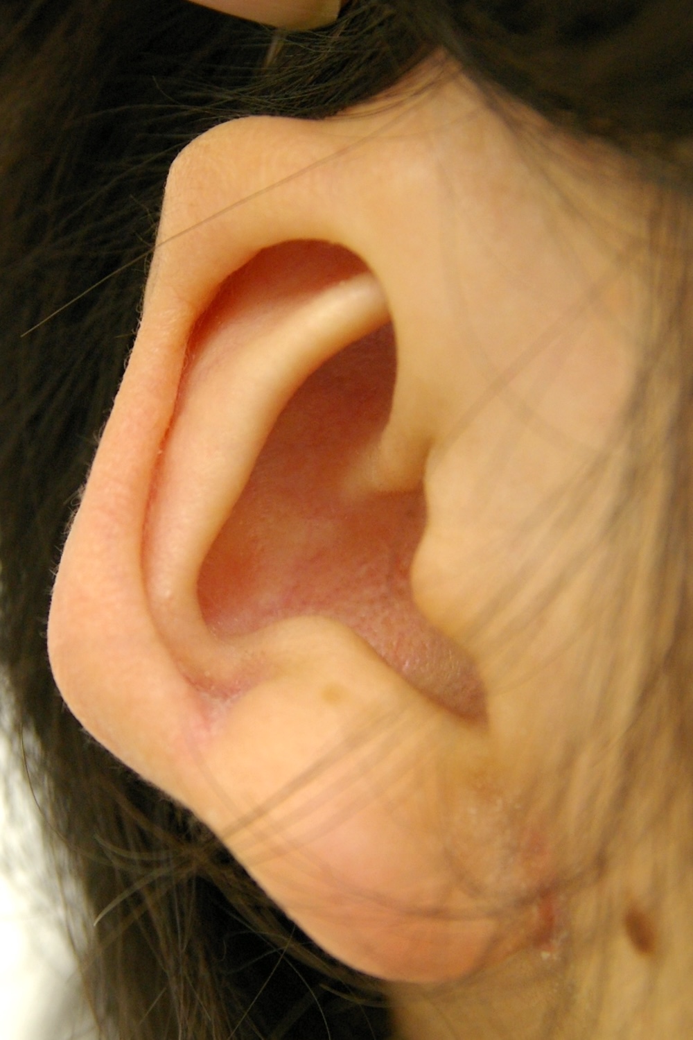 軽度の小耳症術前　大江橋クリニック