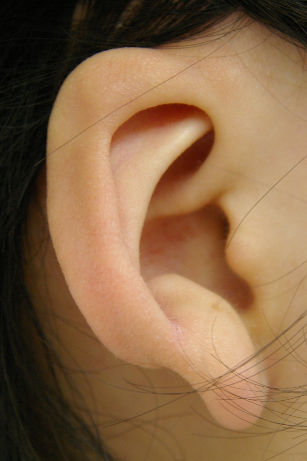 軽度の小耳症術前　大江橋クリニック