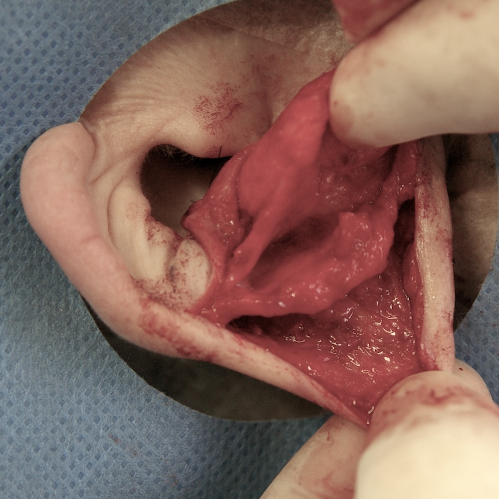 耳介形成術中の軟骨形成