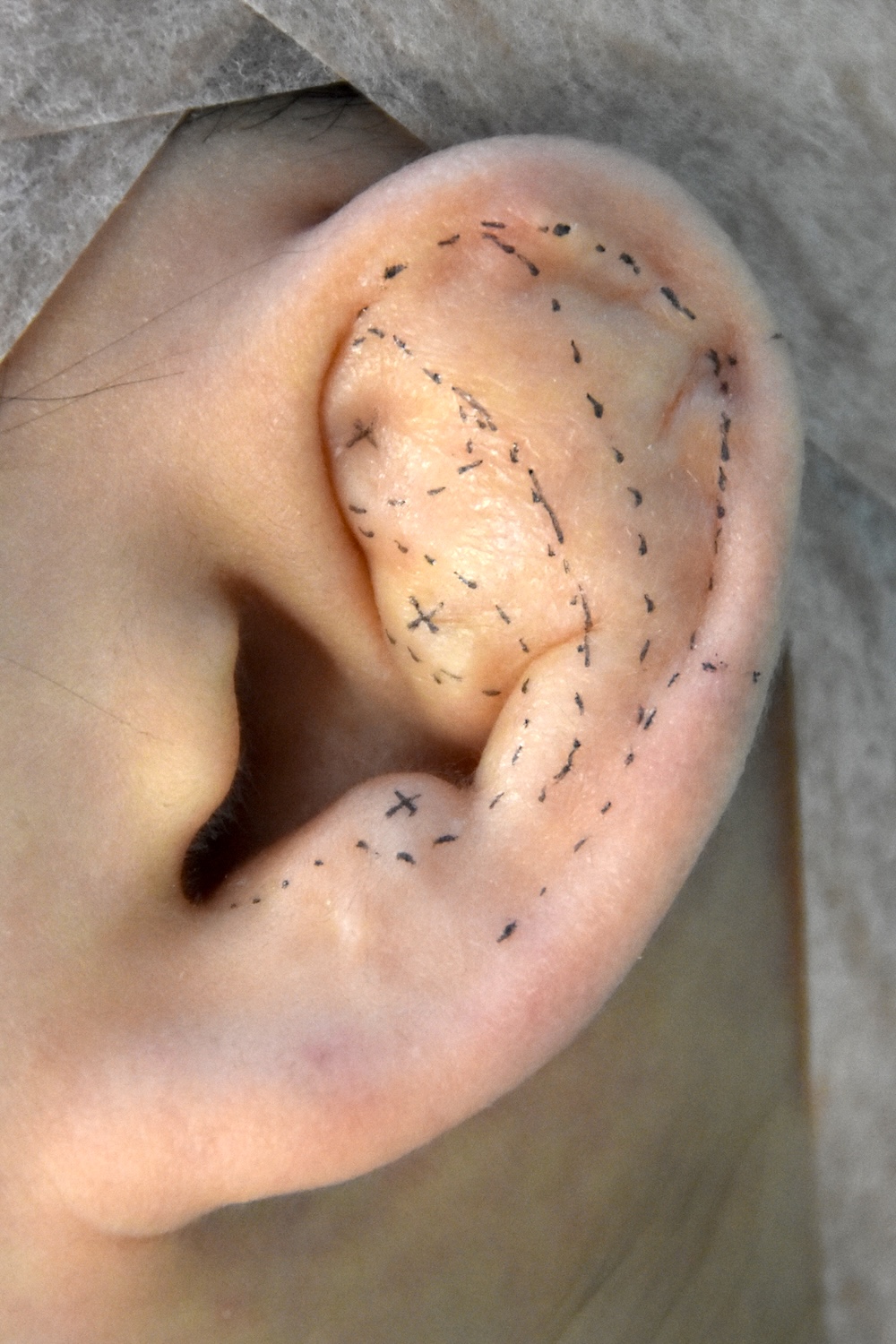 柔道耳手術中　大江橋クリニック