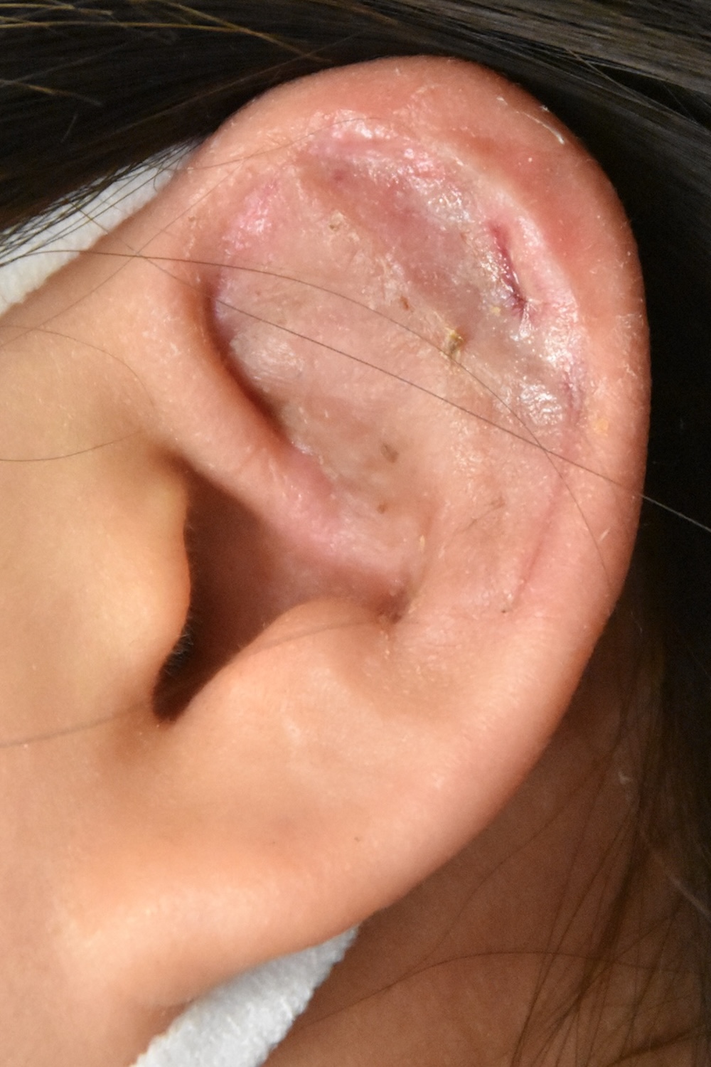 柔道耳術後　大江橋クリニック