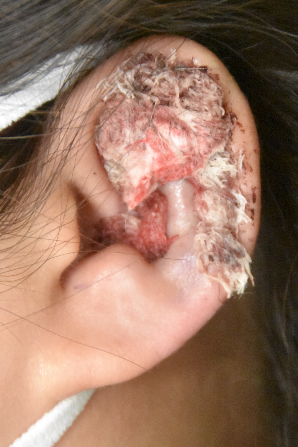 柔道耳術後　大江橋クリニック