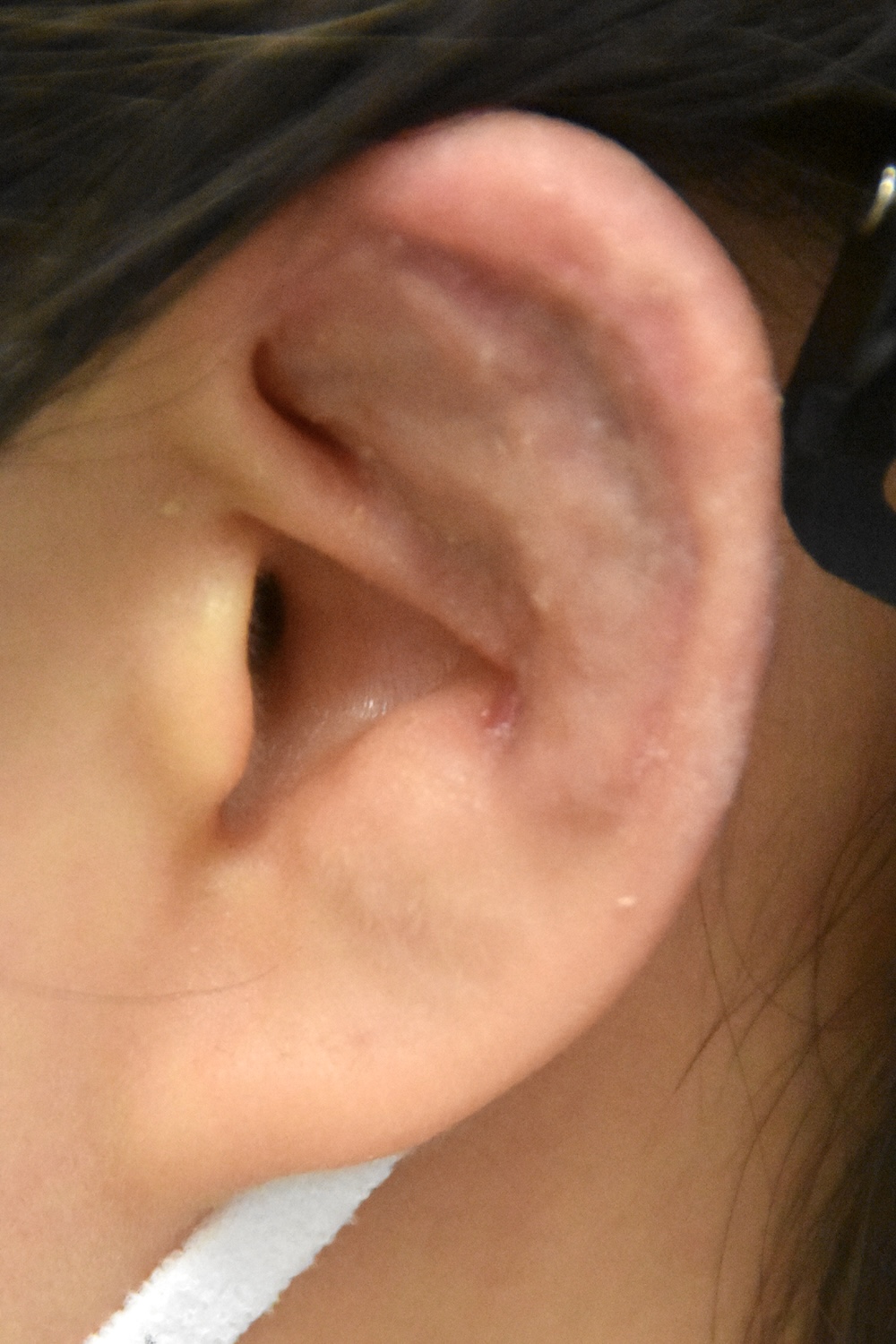 柔道耳術後　大江橋クリニック