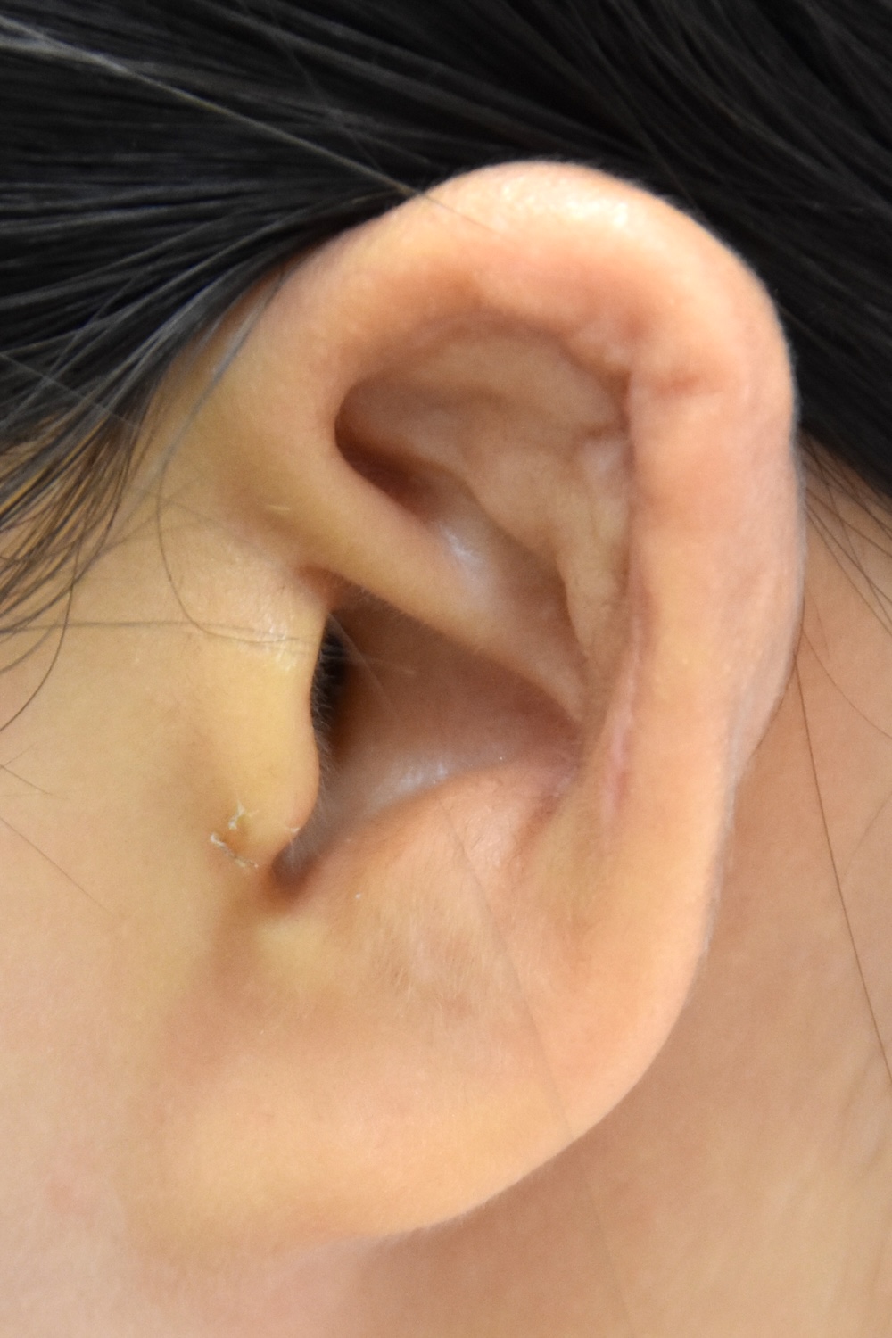 柔道耳術後　大江橋クリニック