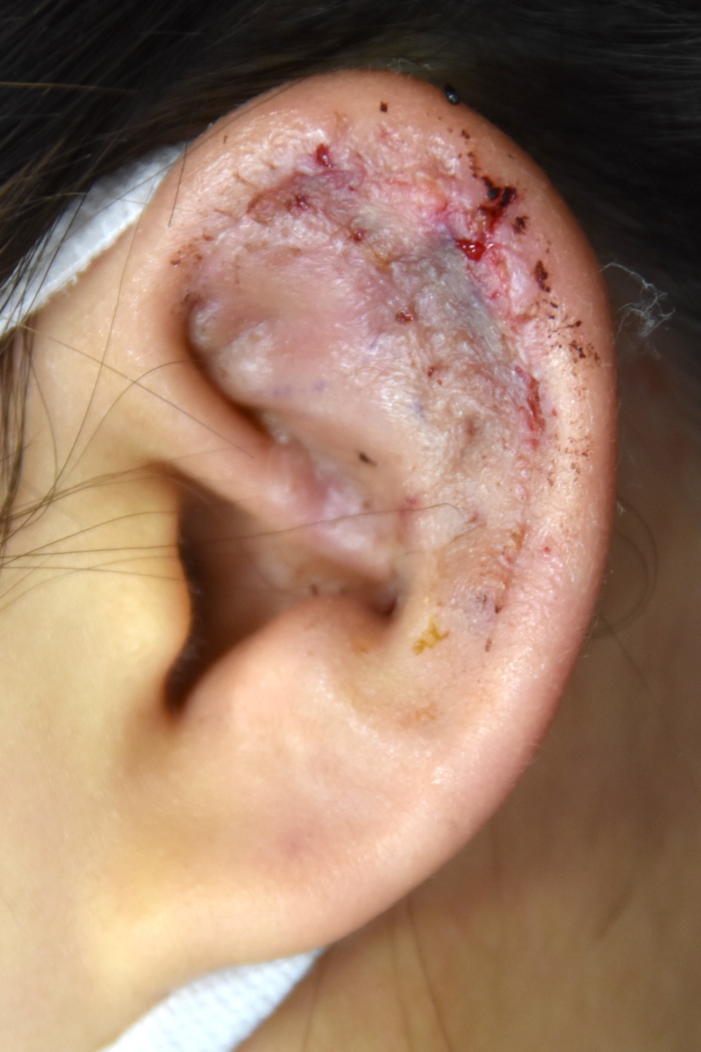 柔道耳術後　大江橋クリニック