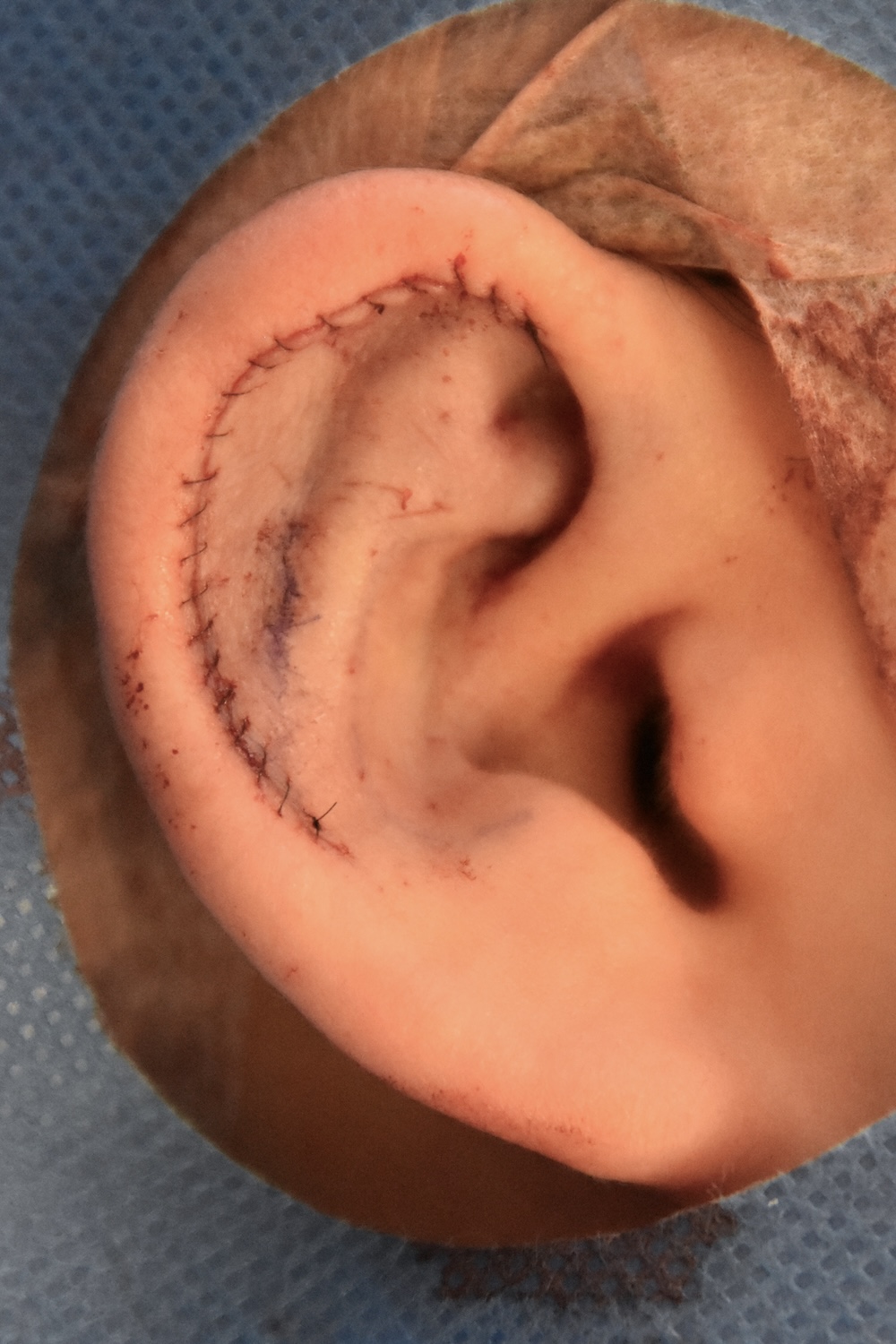 柔道耳手術中　大江橋クリニック