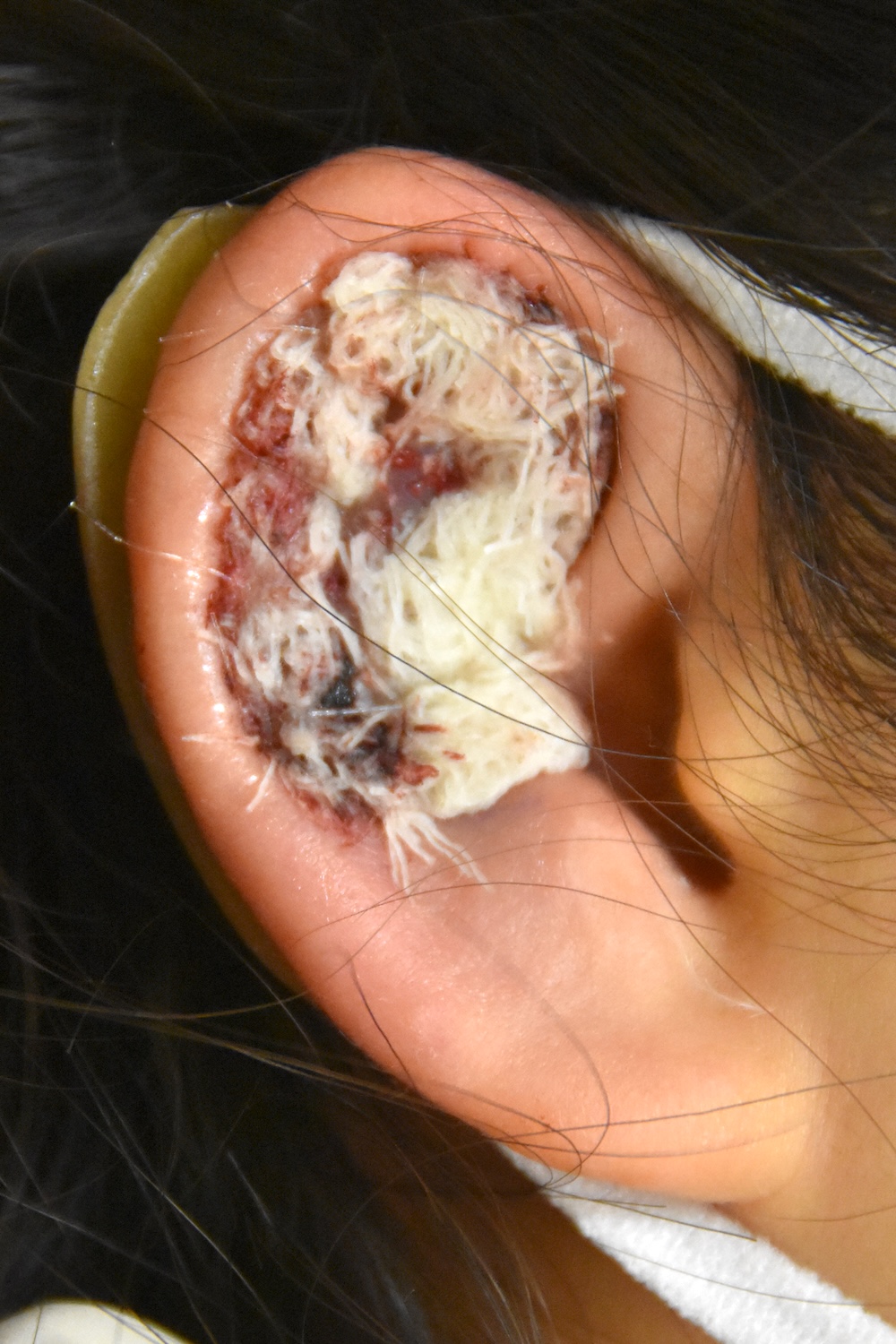 柔道耳術後　大江橋クリニック