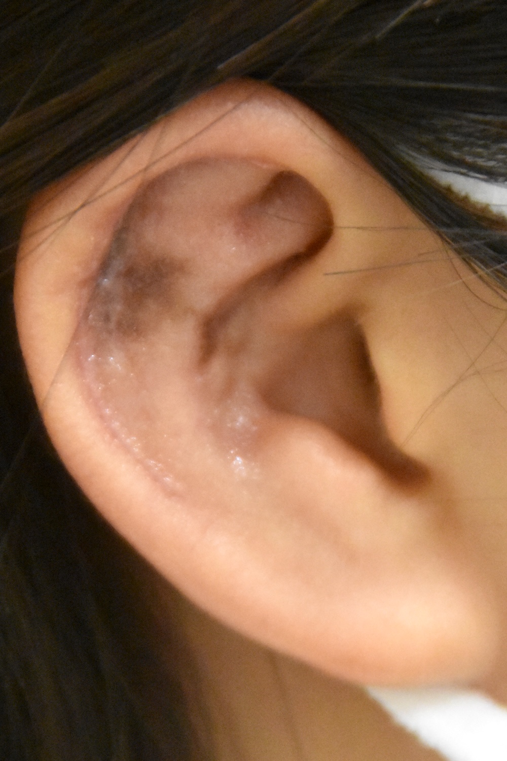 柔道耳術後　大江橋クリニック