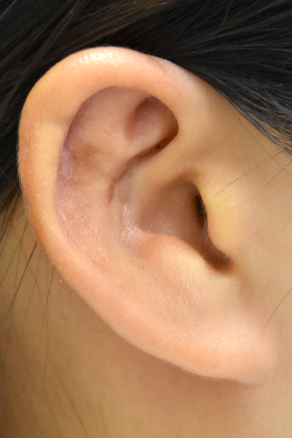 柔道耳術後　大江橋クリニック