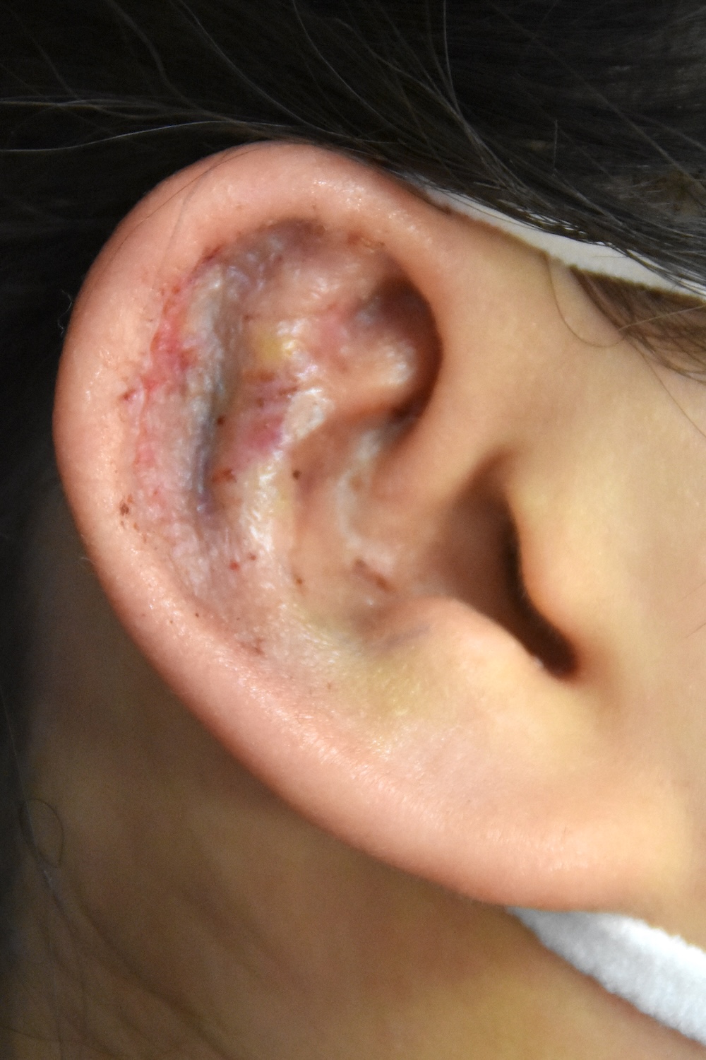 柔道耳術後　大江橋クリニック