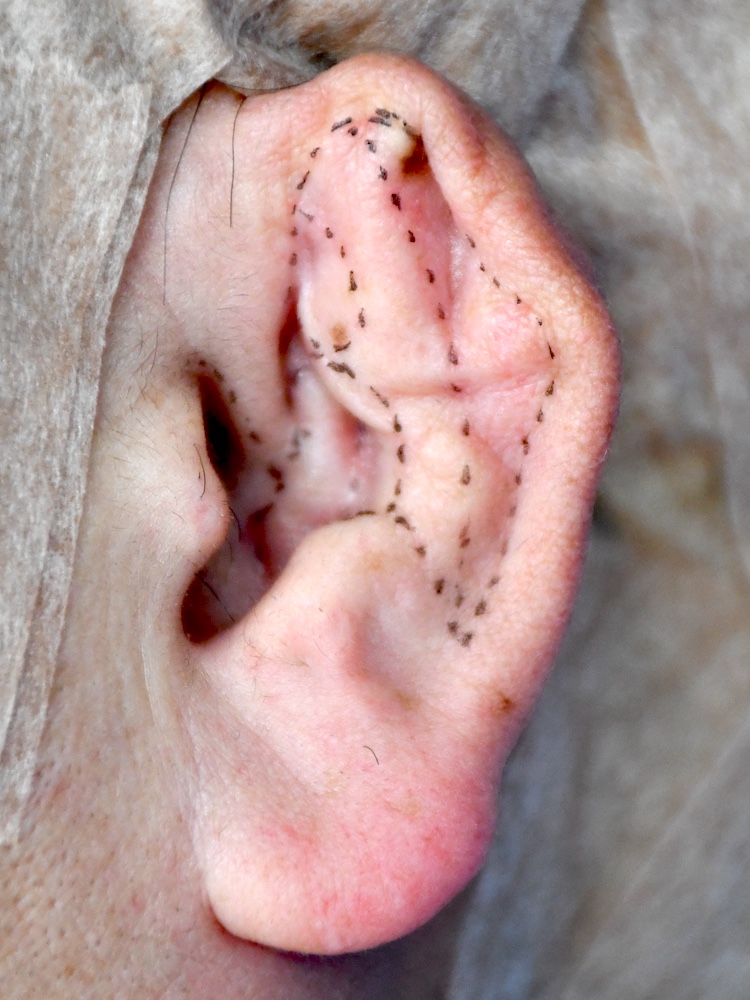 柔道耳術前　大江橋クリニック