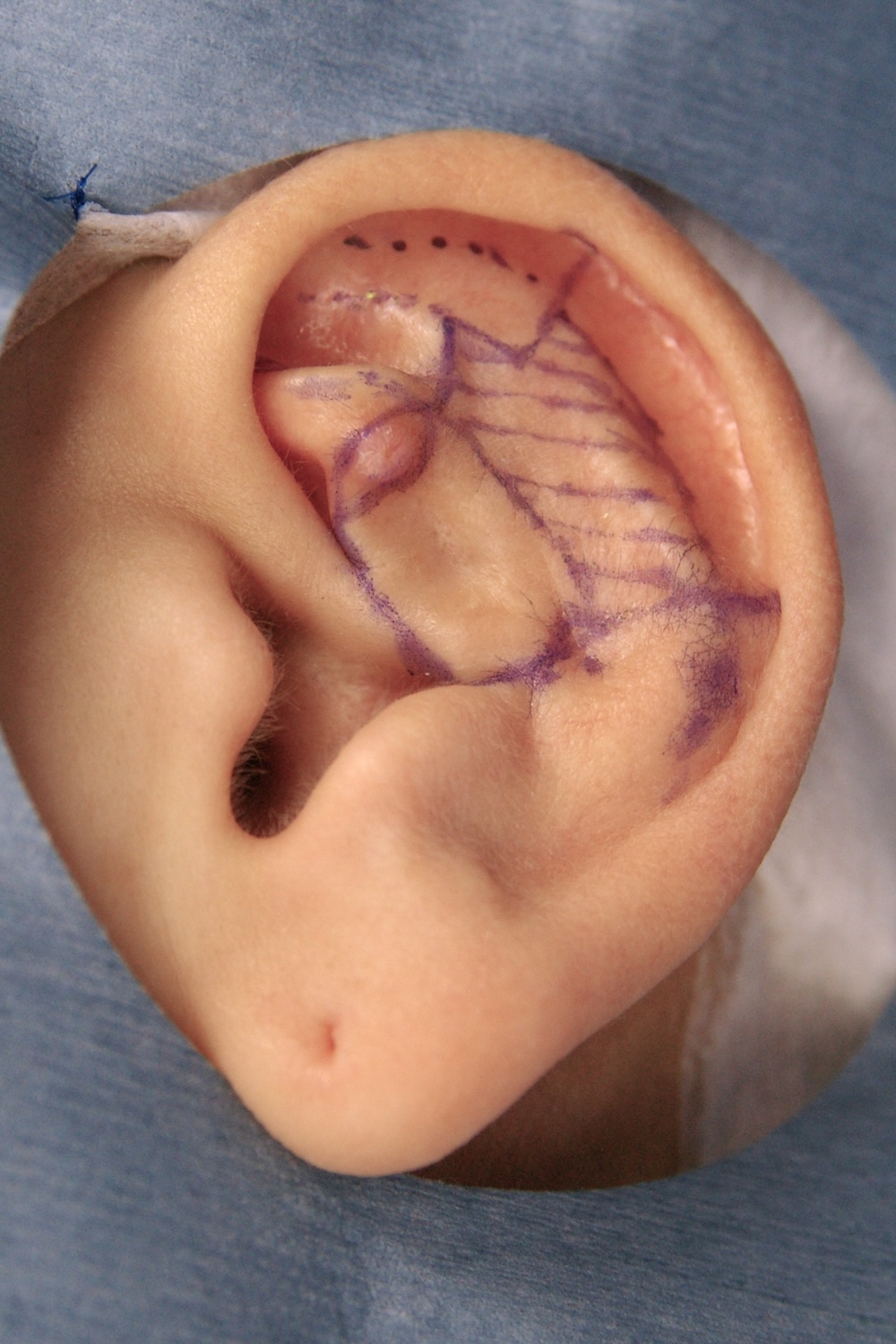 外傷性耳介変形術中　大江橋クリニック