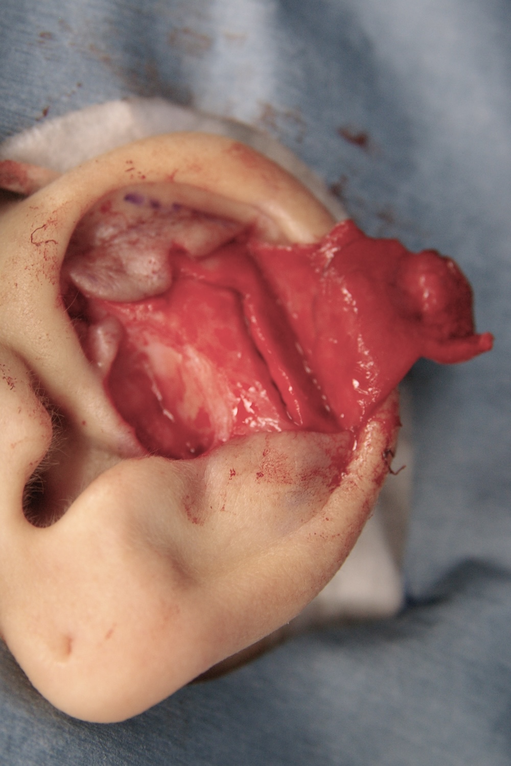 外傷性耳介変形術中　大江橋クリニック