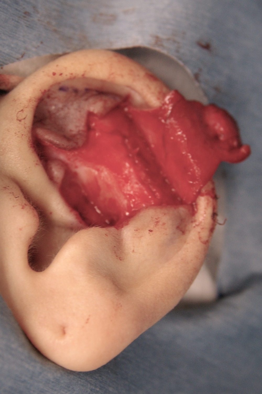 外傷性耳介変形術中　大江橋クリニック