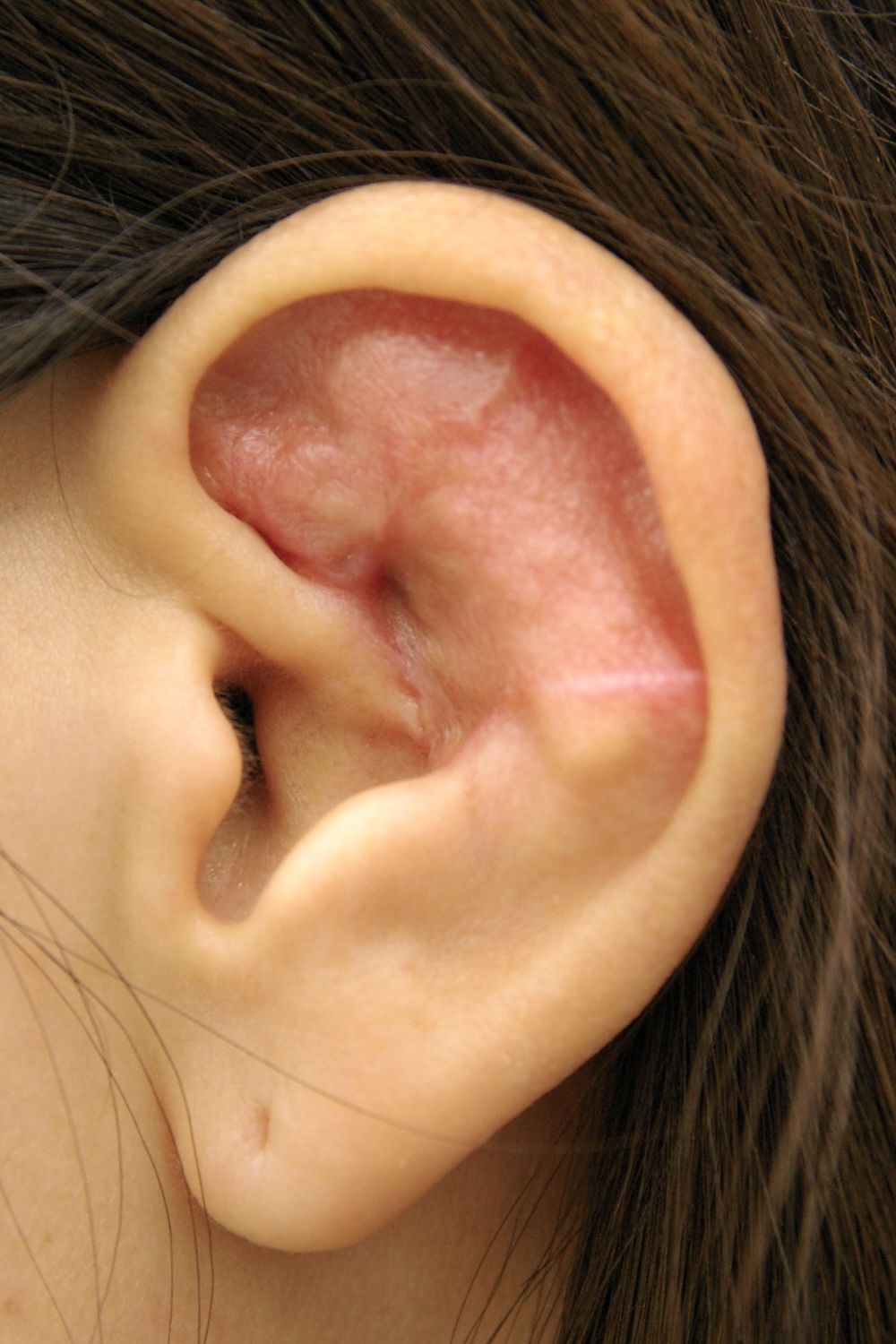 外傷性耳介変形術後　大江橋クリニック