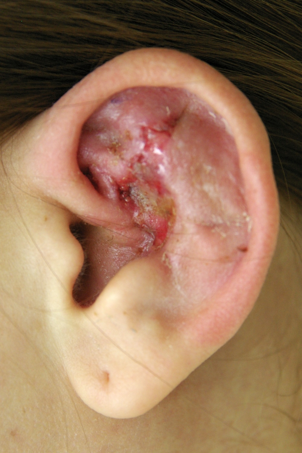 外傷性耳介変形術後　大江橋クリニック