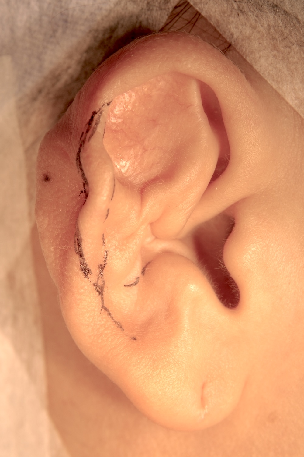 外傷性耳介変形術中　大江橋クリニック