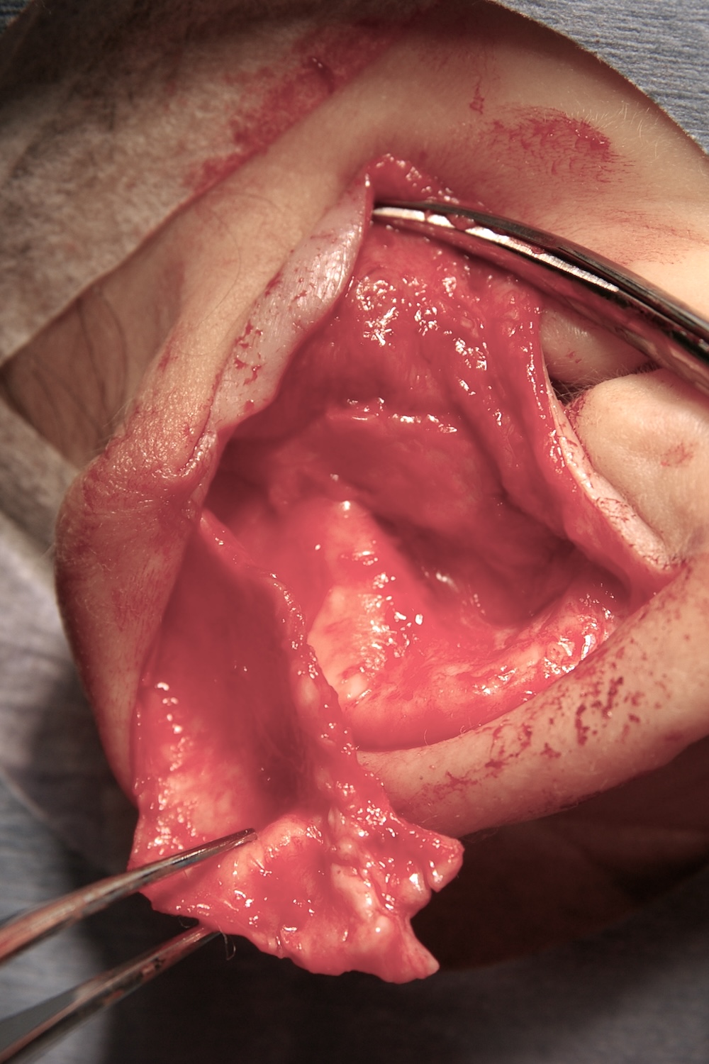 外傷性耳介変形術中　大江橋クリニック