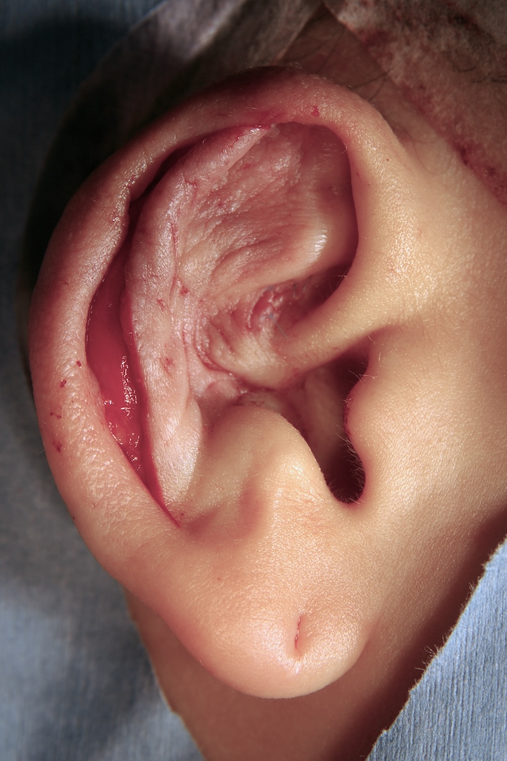 外傷性耳介変形術中　大江橋クリニック