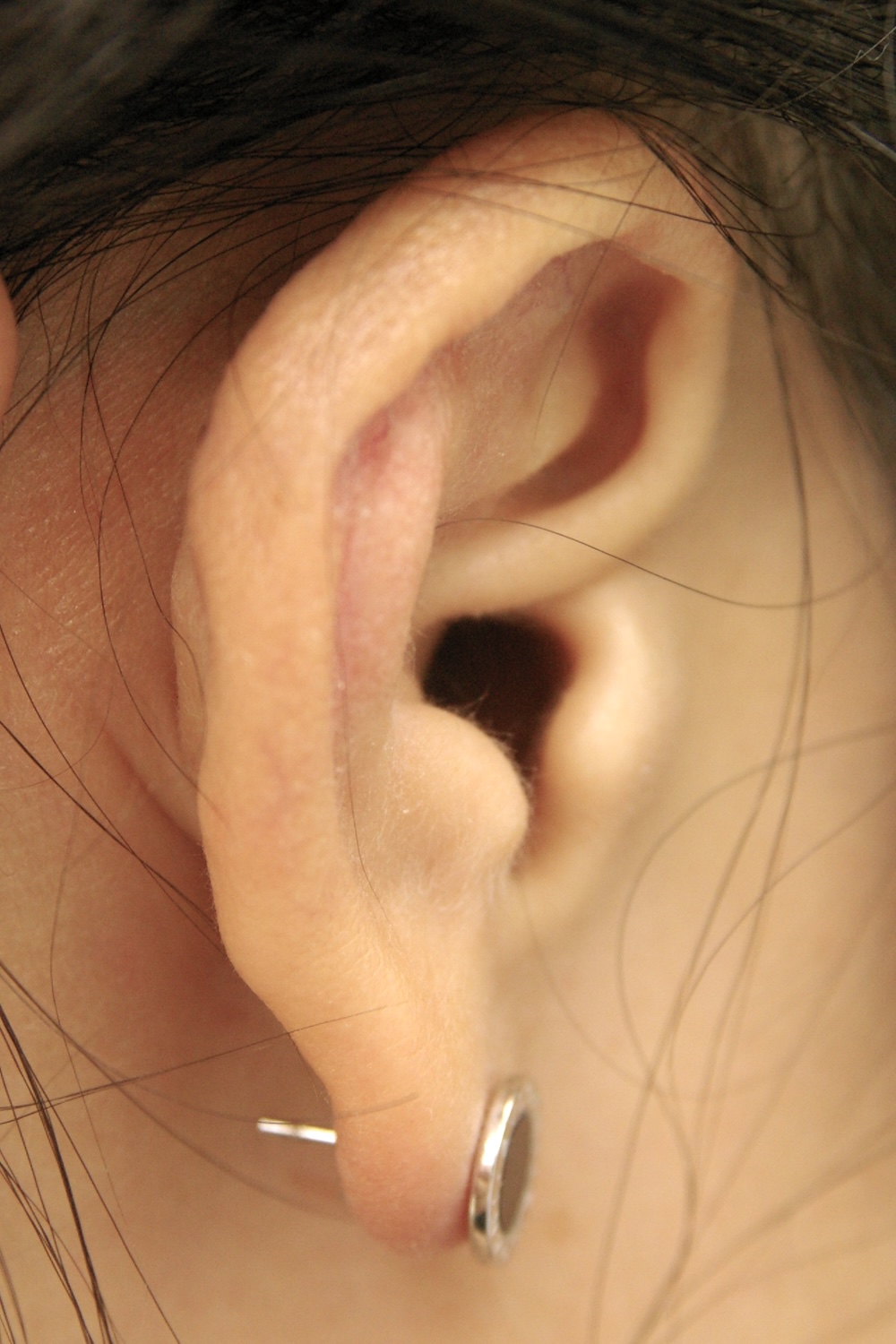 外傷性耳介変形術後　大江橋クリニック