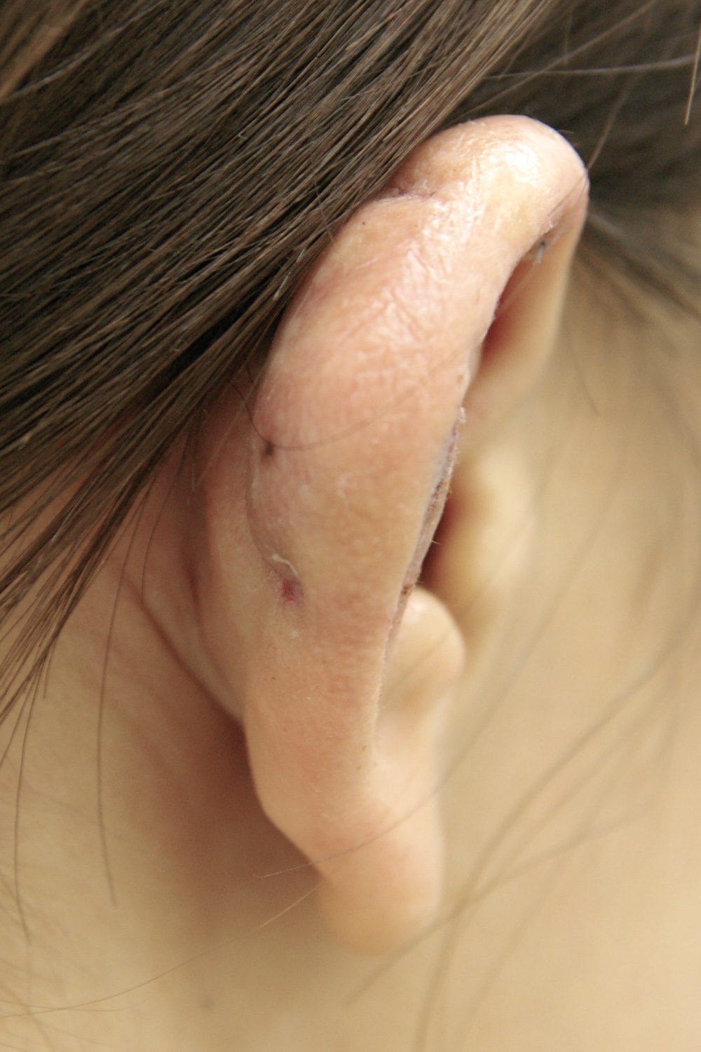 外傷性耳介変形術後　大江橋クリニック