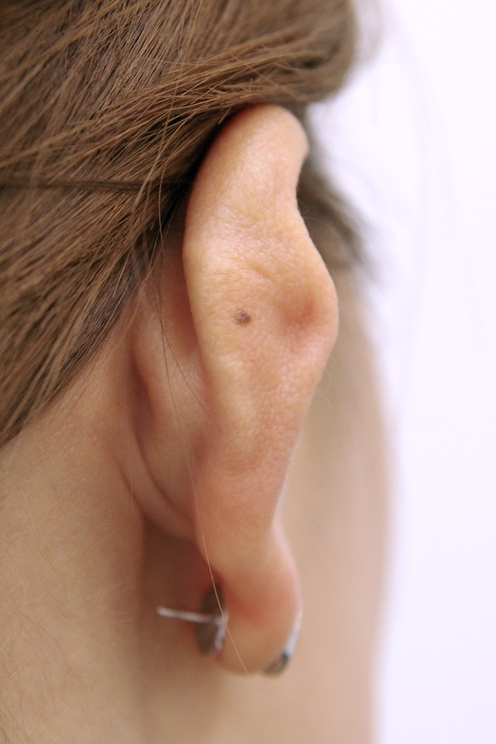 外傷性耳介変形術前　大江橋クリニック