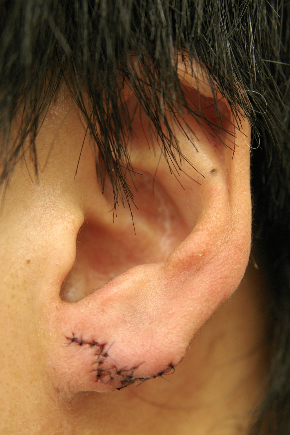 耳たぶの整形術後　大江橋クリニック