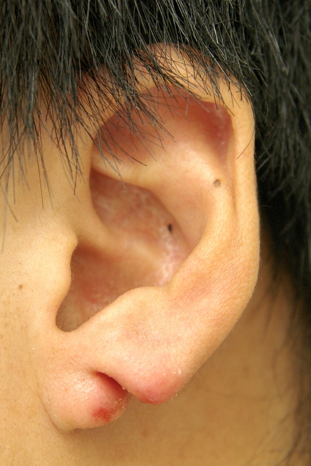 耳たぶの整形術前　大江橋クリニック