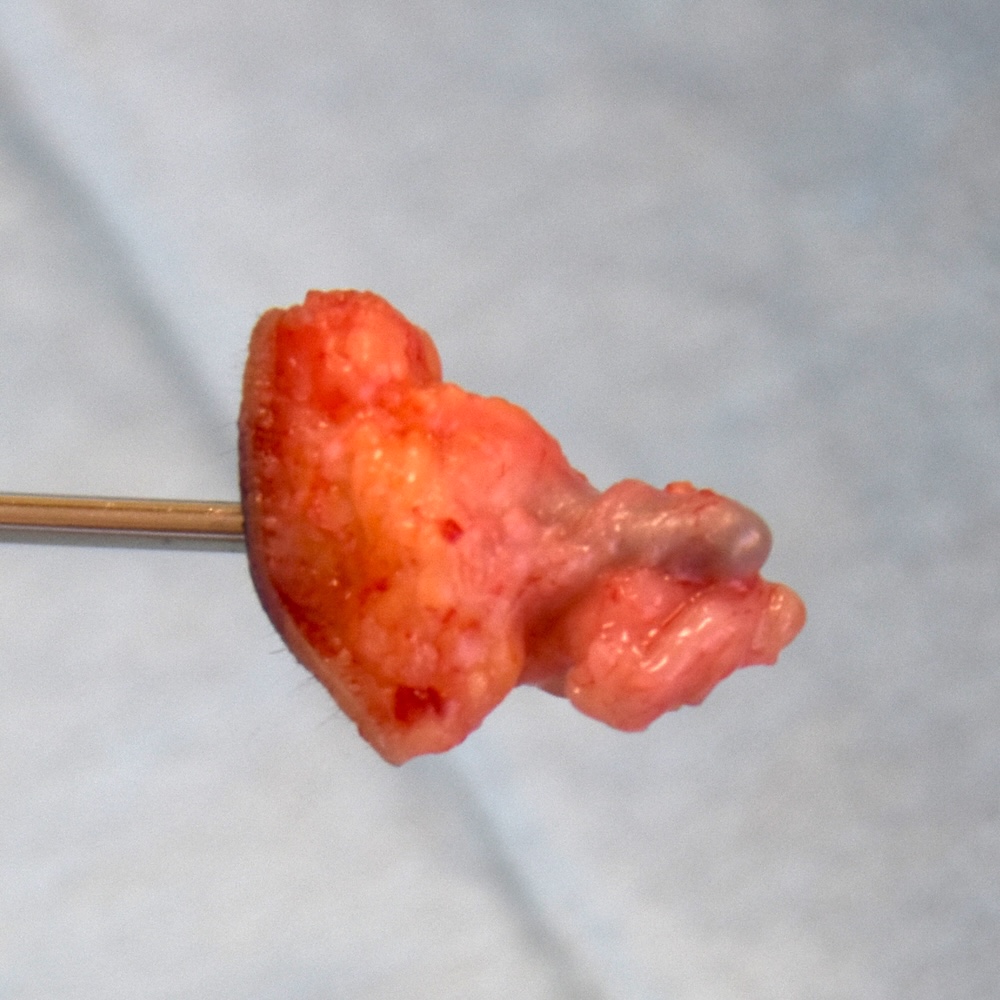 先天性耳瘻管術後　大江橋クリニック