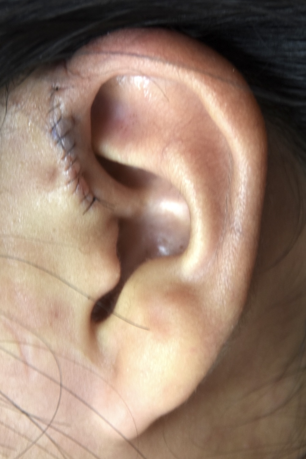 先天性耳瘻管術後　大江橋クリニック