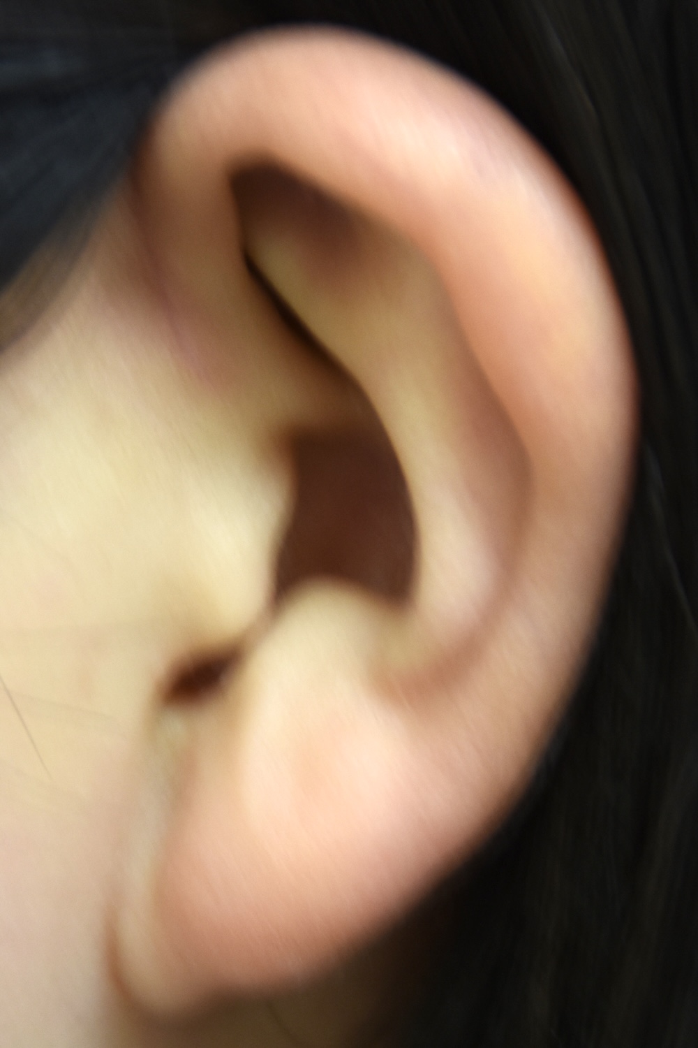 先天性耳瘻管術後　大江橋クリニック