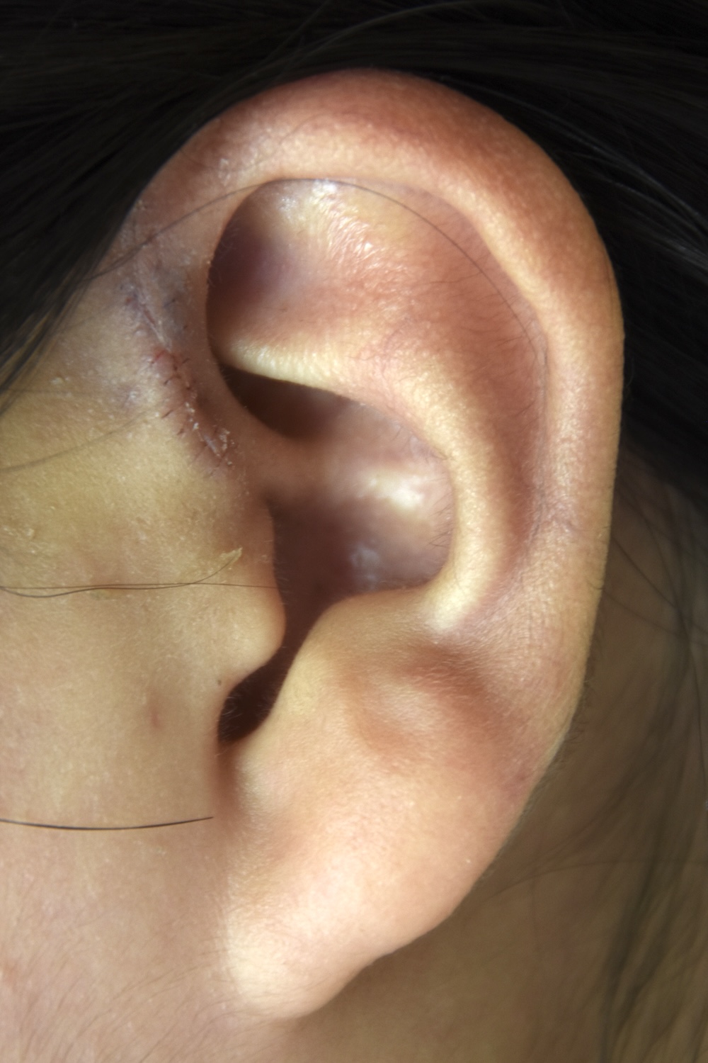 先天性耳瘻管術後　大江橋クリニック