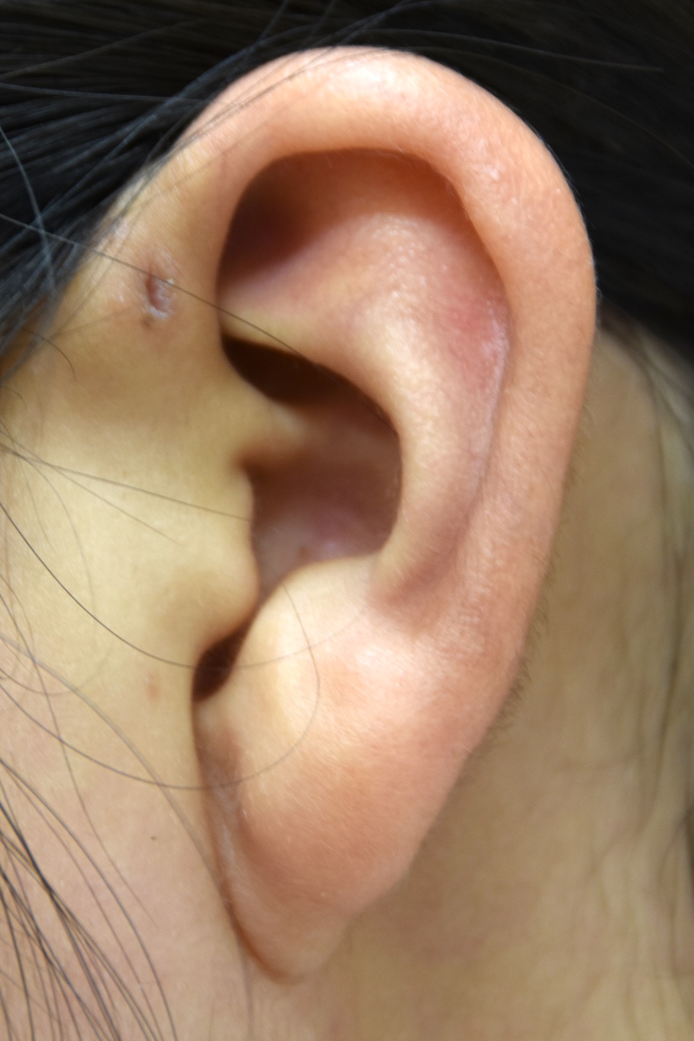 先天性耳瘻管術前　大江橋クリニック