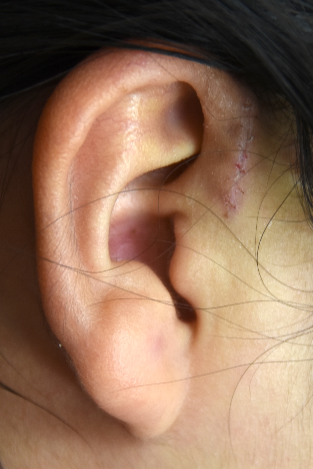 先天性耳瘻管術後　大江橋クリニック