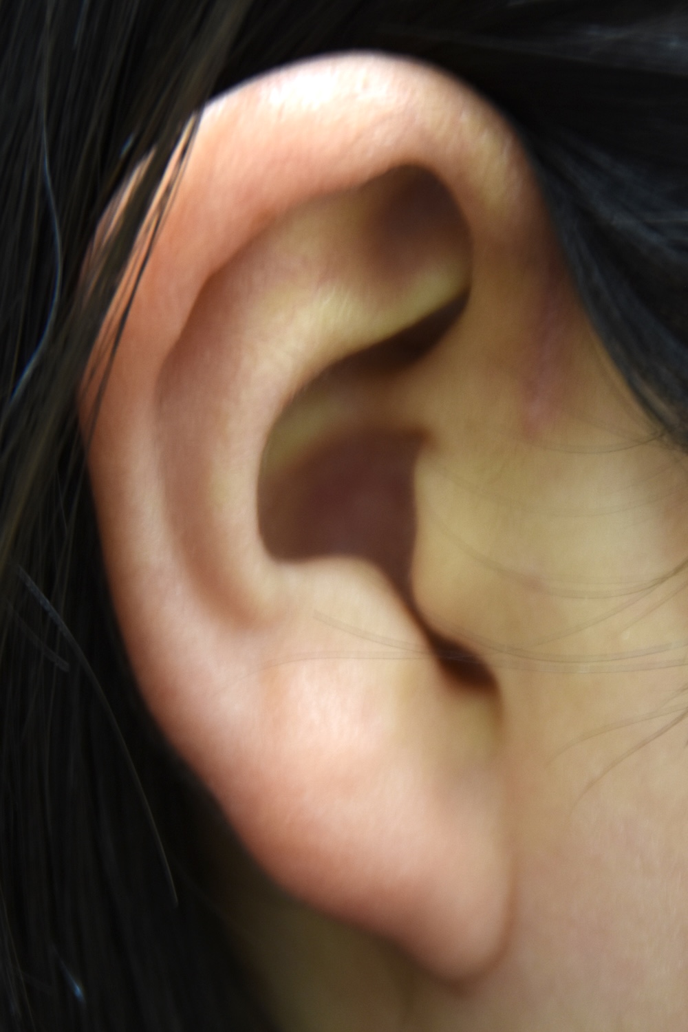 先天性耳瘻管術後　大江橋クリニック