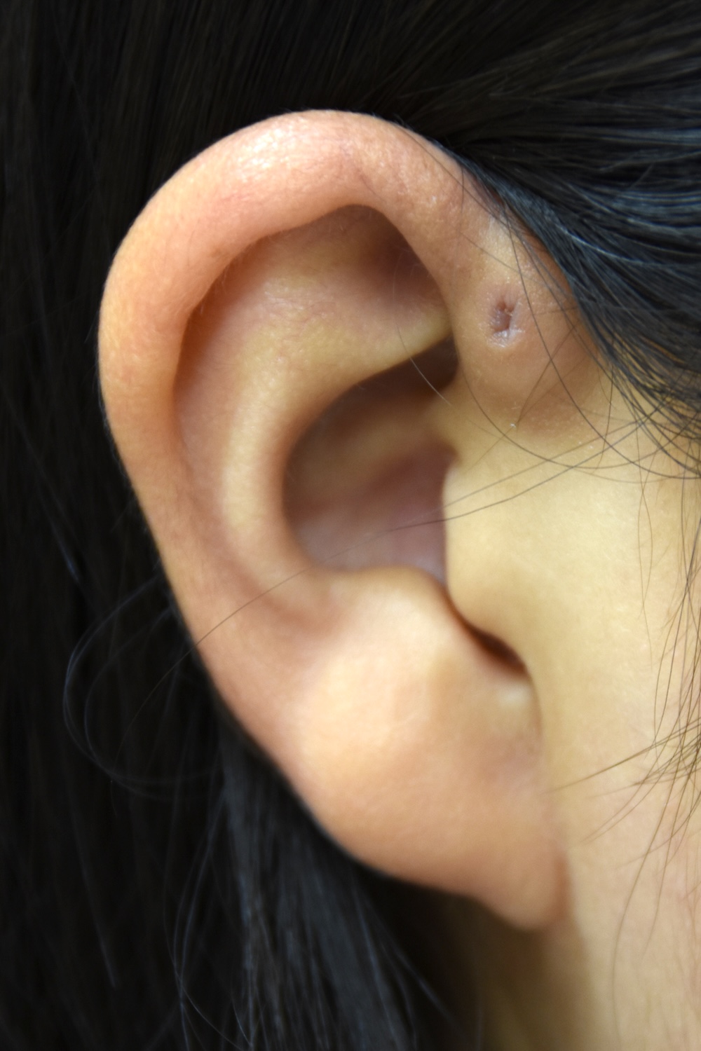 先天性耳瘻管術前　大江橋クリニック