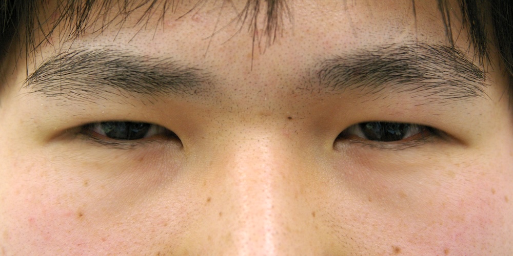 眼瞼瘢痕他院修正術前　大江橋クリニック