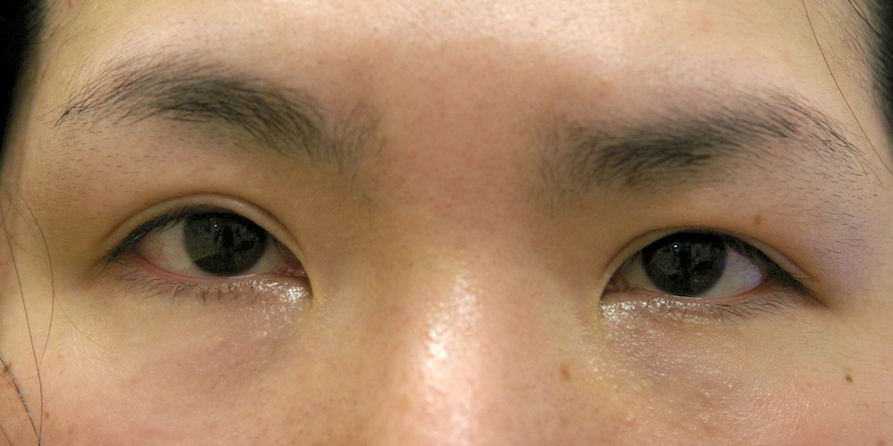 眼瞼瘢痕他院修正術後　大江橋クリニック