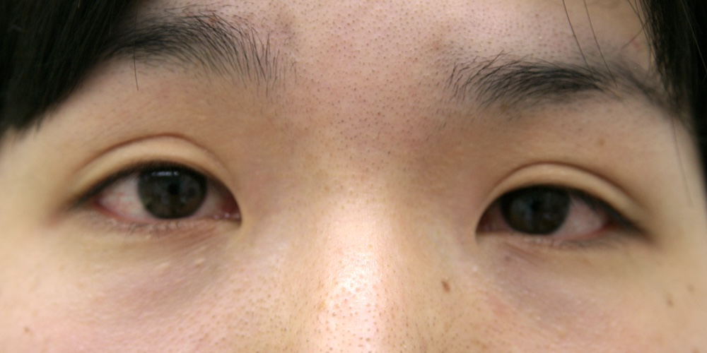 眼瞼瘢痕他院修正術前　大江橋クリニック