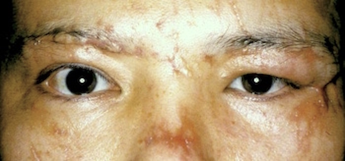 男性顔面外傷瘢痕術前　大江橋クリニック