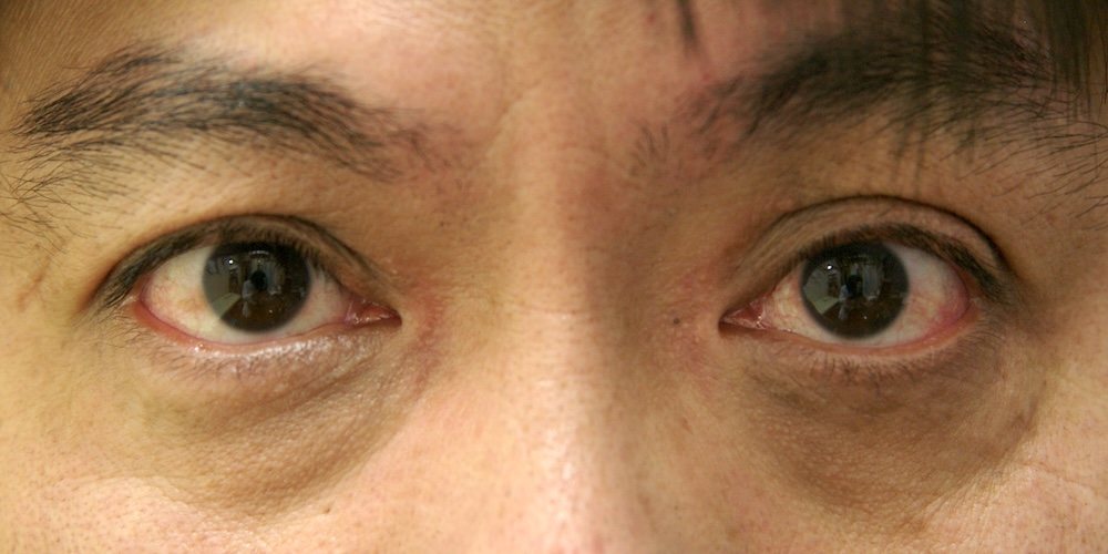 男性眼瞼黄色腫術前　大江橋クリニック